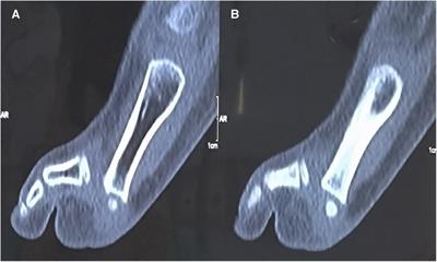 Traumatic irreducible dislocation of the fifth metatarsophalangeal joint in pediatrics: case report and clinical experience